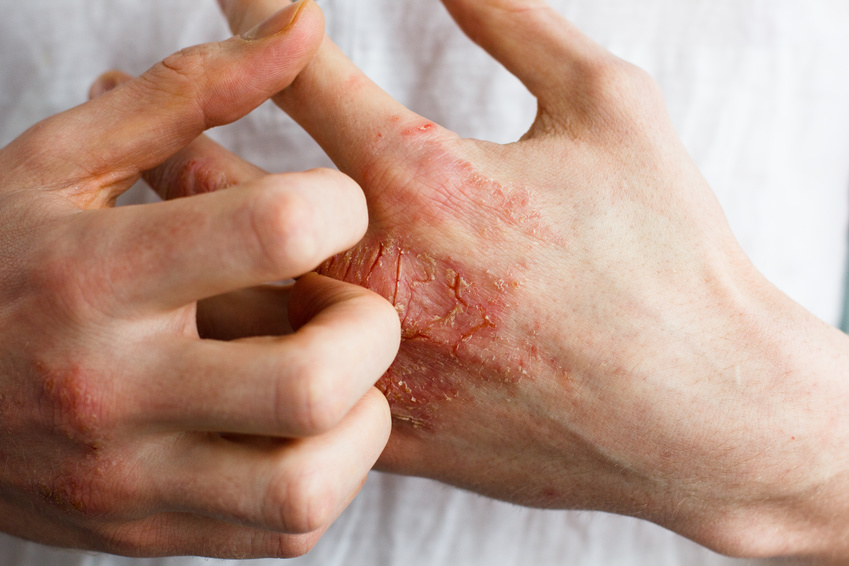 Eczéma causé par le stress : Découvrez nos 3 conseils pour être mieux dans votre peau