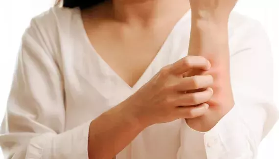 Comment soigner l"urticaire causée par le stress ?