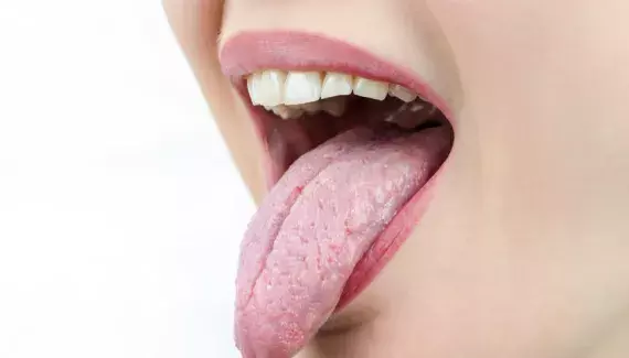 remédier à la langue blanche (saburrale) due au stress